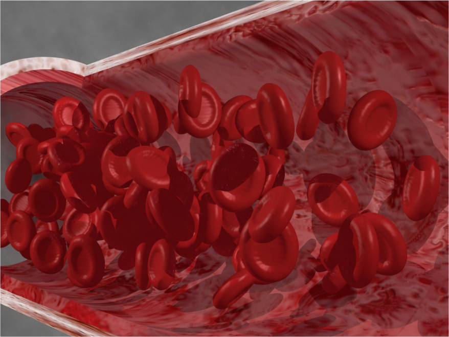 Diagnostics-IND-SPgs-Anemia